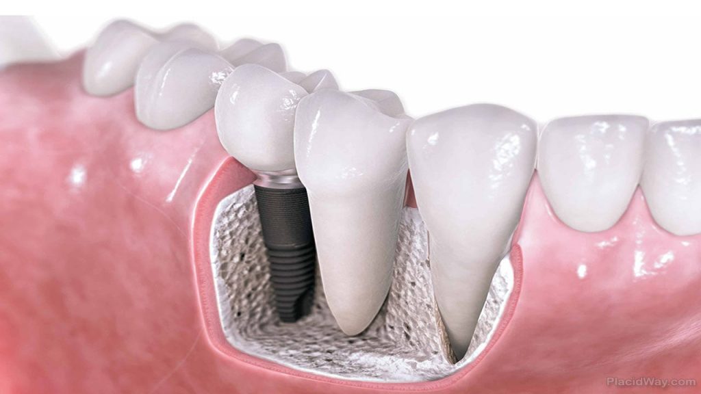 How to take care of dental implants