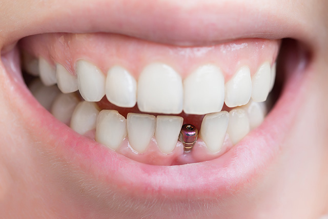 dental implant front teeth