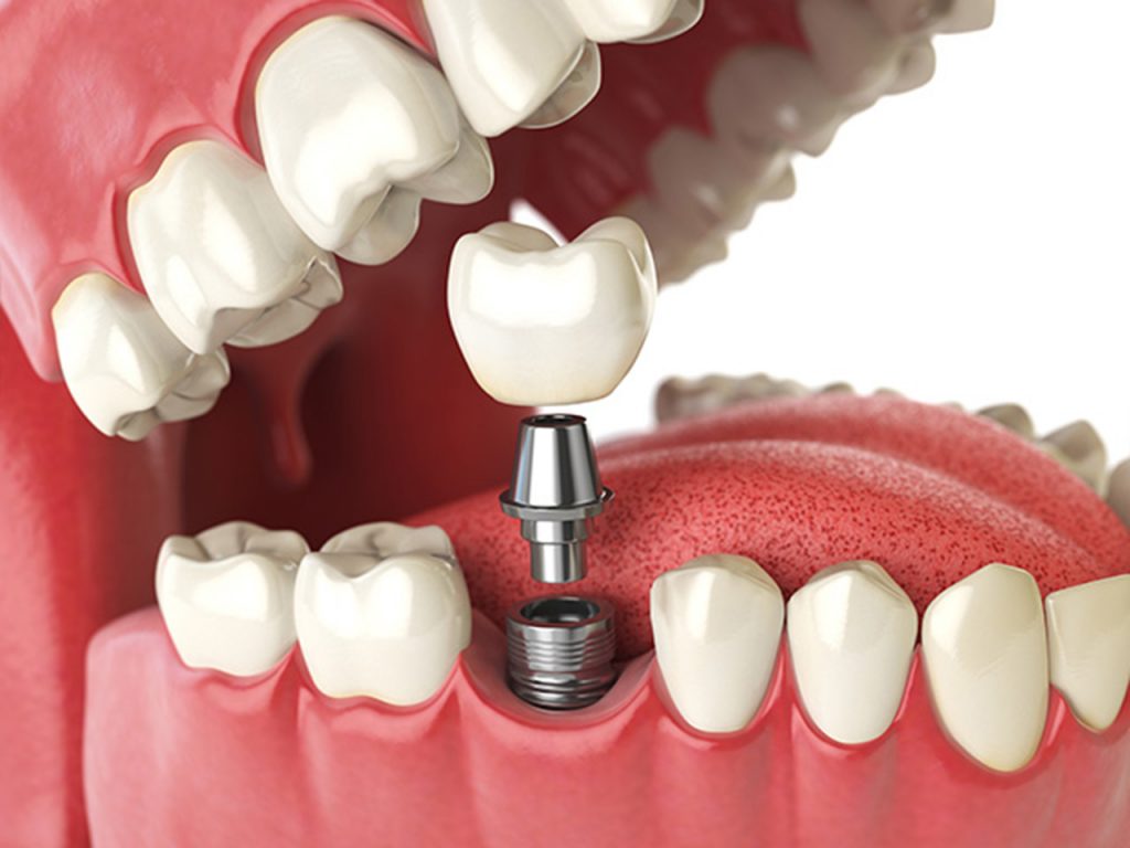 dental implant maintenance