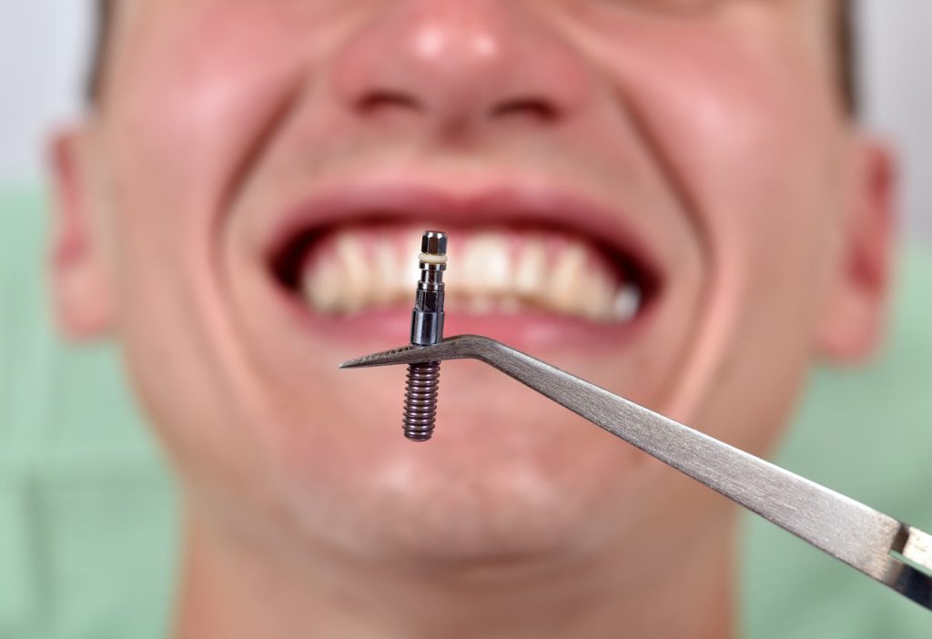 Preventing Dental Implant Failure