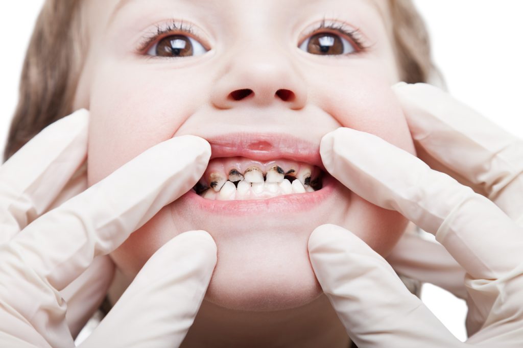 Children With Rotten Teeth
