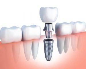 missing tooth replacement options