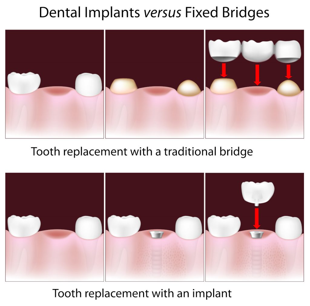 Dental Bridge Vs Implant