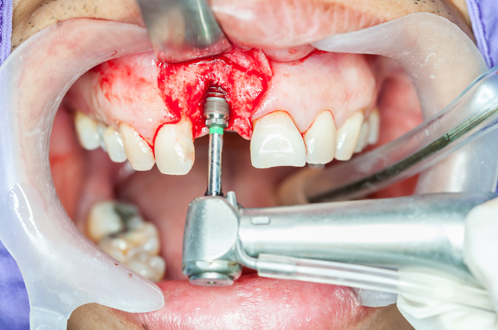 Dental Implants Side Effects