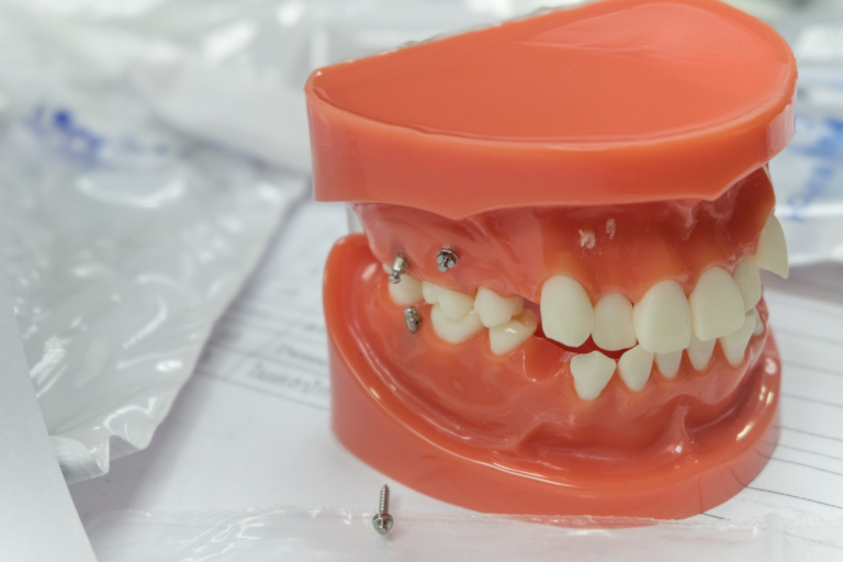 Dental Mini-Implants Success Rates