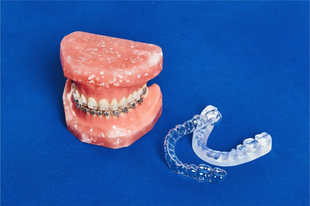 clear braces cost vs metal braces cost