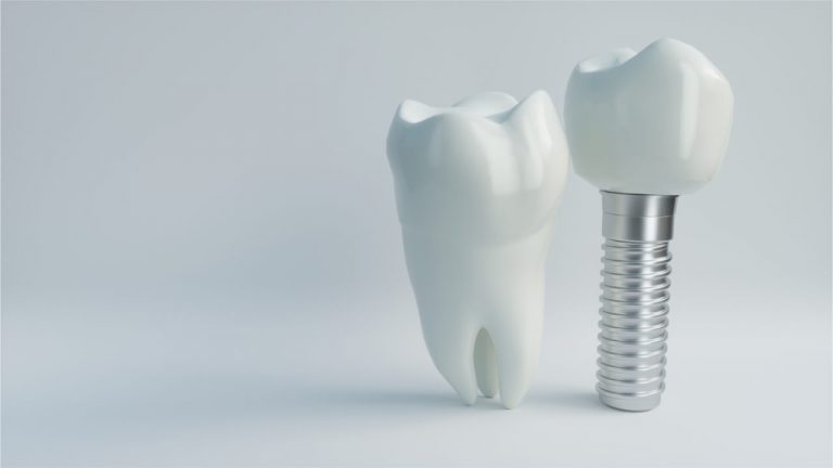 All On 4 Dental Implant Risks