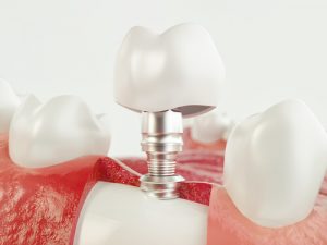 Can Dental Implants Make You Sick