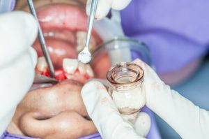 dental implant repair