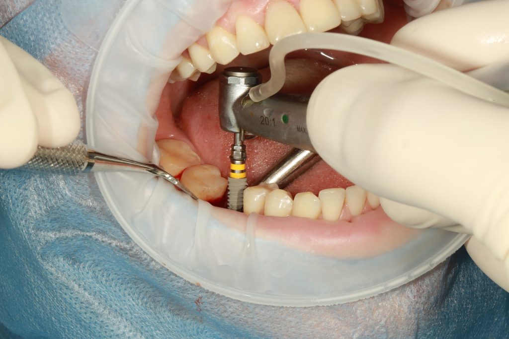 dental implant rejection symptoms