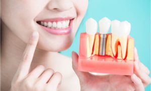 dentures vs implants
