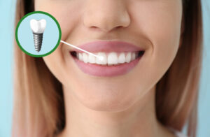 dental implant appearance