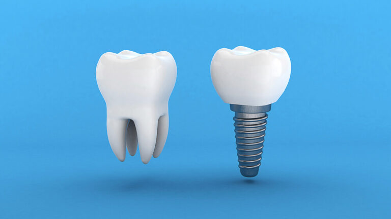 Revolutionizing Smiles: The Future of Dentistry with A Metal Tooth Implant