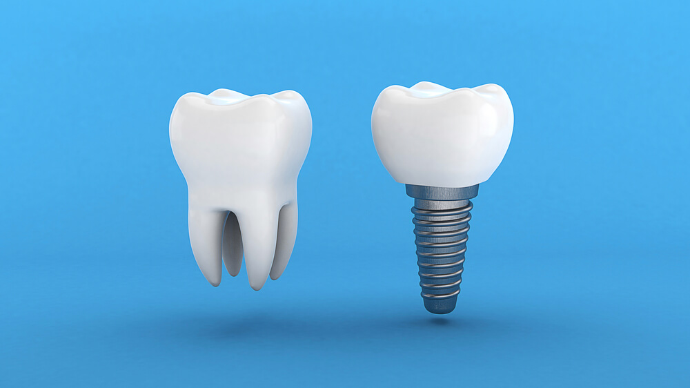 metal tooth implant
