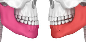 top teeth shorter lower jaw